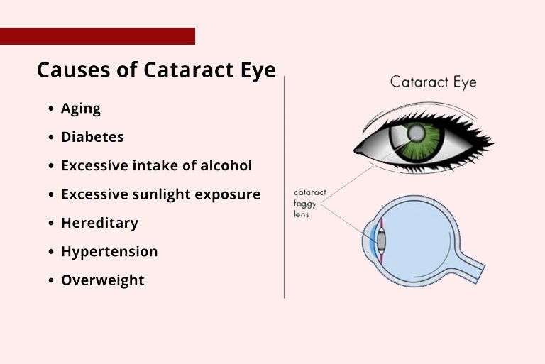  Best Eye Hospital In Kolkata , Best ophthalmologist in Kolkata , Best Eye specialists in Kolkata , Top eye hospital in Kolkata , causes Of Cataracts Eye 