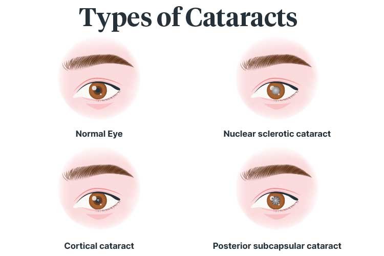 Best Eye Hospital In Kolkata , Best ophthalmologist in Kolkata , Best Eye specialists in Kolkata , Top eye hospital in Kolkata , risk factors of Cataract , best cataract treatment in Kolkata , what are the risks of cataracts , diagnosis of Cataracts , slit lamp examination , cataract treatment 