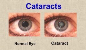 In-depth overview of cataracts, their causes, symptoms, and the latest treatment technologies available at pushpanjali eye care, the premier eye hospital in kolkata.